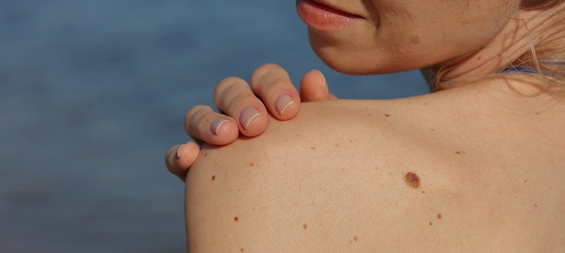 Điều gì sẽ xảy ra nếu bạn bị cháy nắng nhiều lần? 3