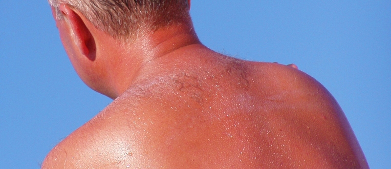 Điều gì sẽ xảy ra nếu bạn bị cháy nắng nhiều lần? 2