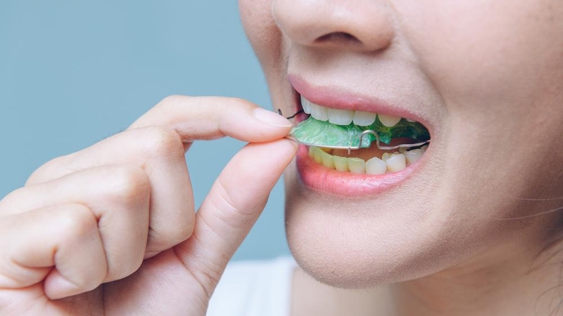 Điều gì xảy ra nếu niềng răng xong không đeo hàm duy trì 4