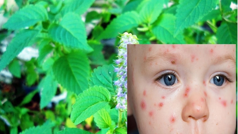 Điều trị bệnh thủy đậu theo đông y an toàn hiệu quả 2