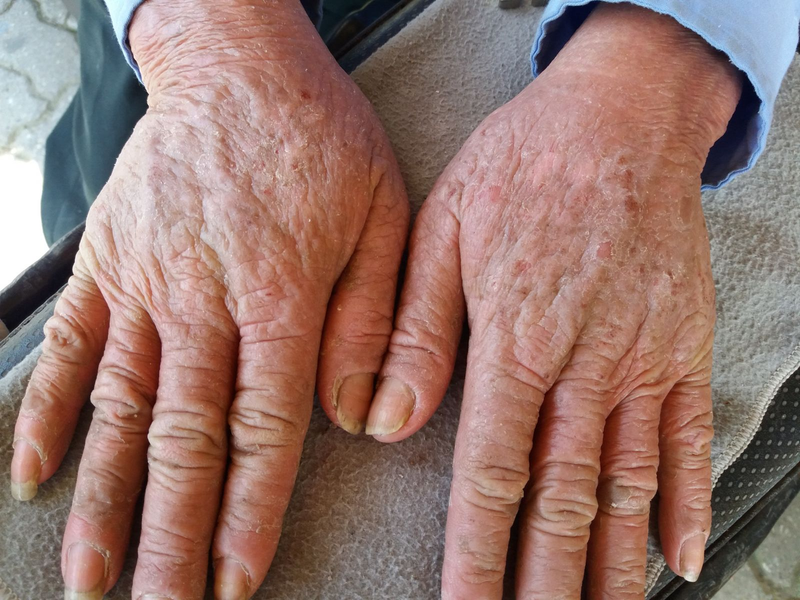 Điều trị da bị dị ứng xi măng hiệu quả 2