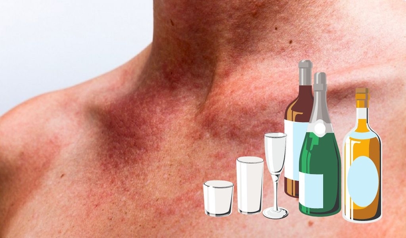 Điều trị dị ứng da khi uống rượu bia và cảnh báo khi dị ứng rượu bia 1