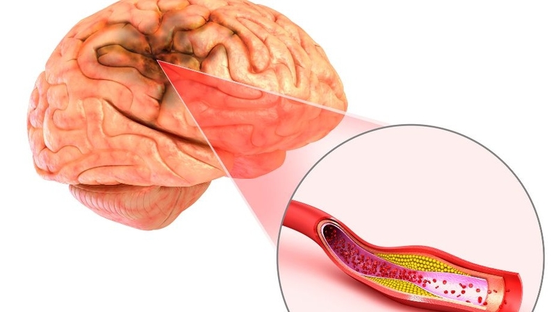 Điều trị đột quỵ nhồi máu não được thực hiện như thế nào? 1