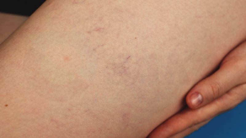 Điều trị giãn mao mạch bằng tia laser có ưu điểm gì?