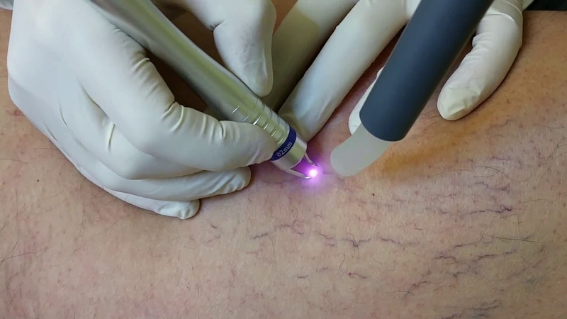 Điều trị giãn mao mạch bằng tia laser có ưu điểm gì?