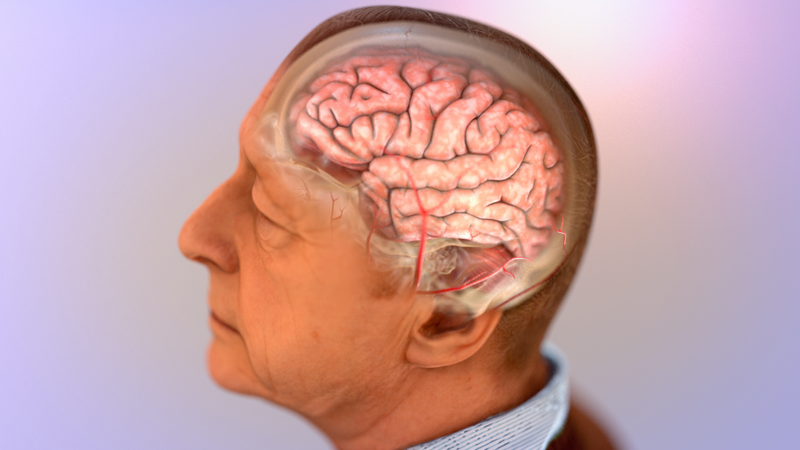 Điều trị hiệu quả bệnh mất trí nhớ Alzheimer khi nhận biết sớm - Hình 1