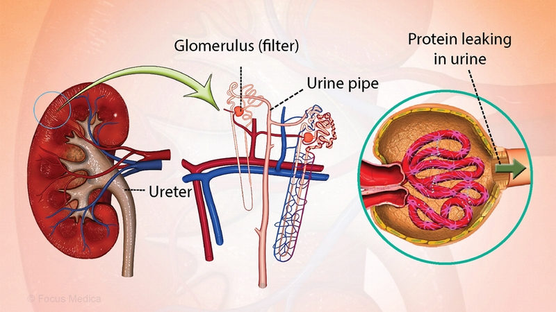 Điều trị hội chứng thận hư bằng thuốc Corticoid 1