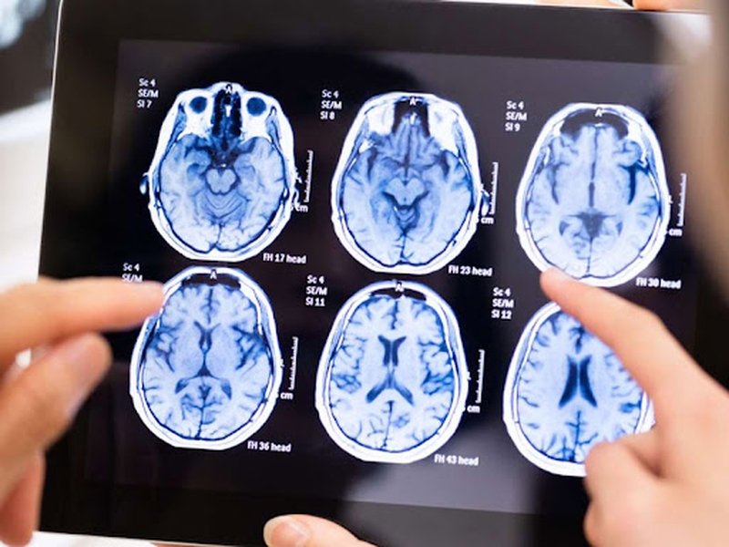 Lao Màng Não Và Cách Điều Trị Lao Màng Não 3