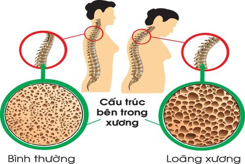 Điều trị loãng xương nặng: Người bệnh cần lưu ý điều gì? 1