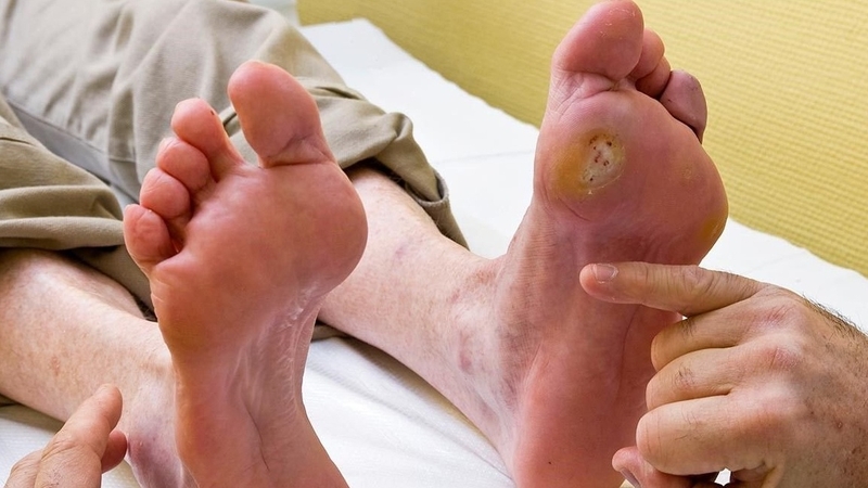 Điều trị vết loét bàn chân tiểu đường như thế nào? 1