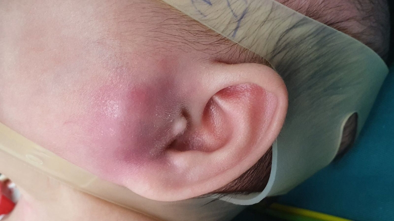 Điều trị nhọt ống tai ngoài an toàn và hiệu quả theo từng giai đoạn