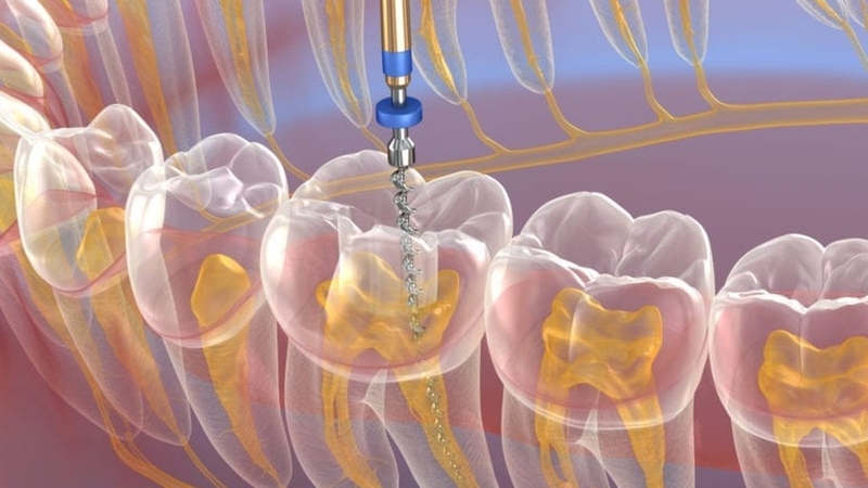 Điều trị nội nha là gì? Tại sao cần phải điều trị nội nha? 4