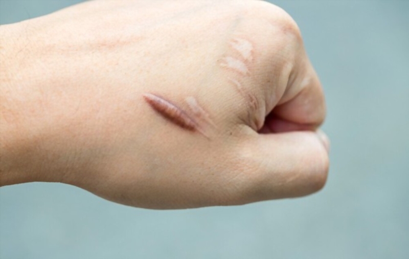 Sẹo đỏ bao lâu thì hết? Cách điều trị sẹo đỏ hiệu quả 1
