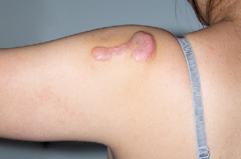 Sẹo phì đại bao lâu thì hết