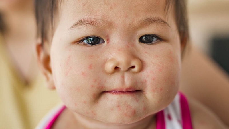 Sốt siêu vi phát ban có thể xảy ra ở mọi đối tượng