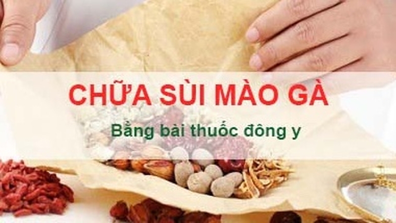 Có nên điều trị sùi mào gà bằng thuốc Đông y không? 1