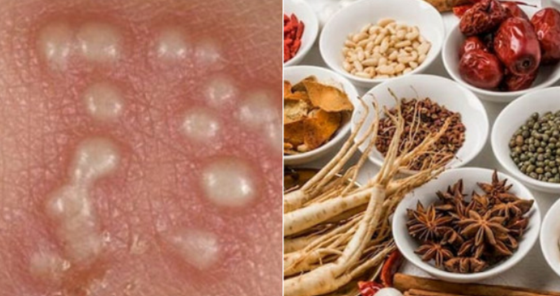 Có nên điều trị sùi mào gà bằng thuốc Đông y không? 3