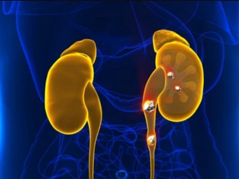 Điều trị thận đa nang tự phát như thế nào? 2