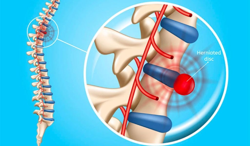 Điều trị thoát vị đĩa đệm bằng laser là gì? Quy trình thực hiện và cách chăm sóc 2