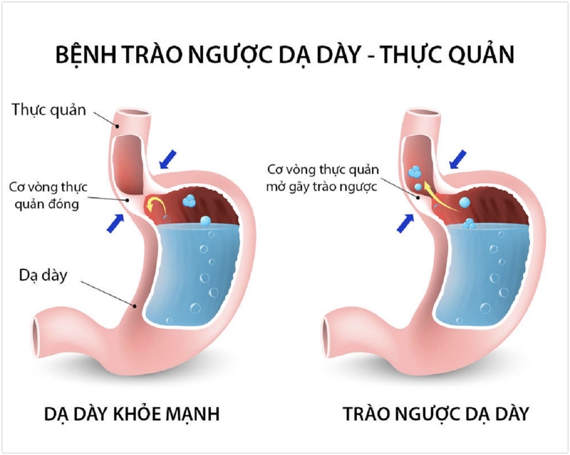 Điều trị trào ngược dạ dày thực quản làm sao cho hiệu quả? 1