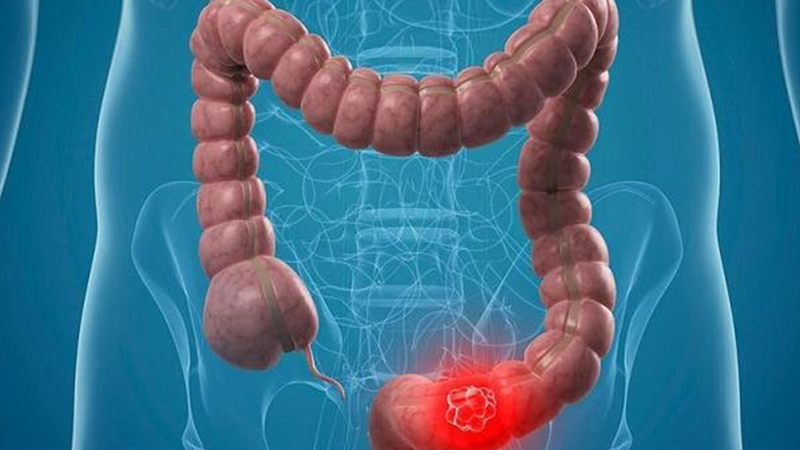 Điều trị ung thư đại trực tràng cần dựa trên thể trạng bệnh nhân