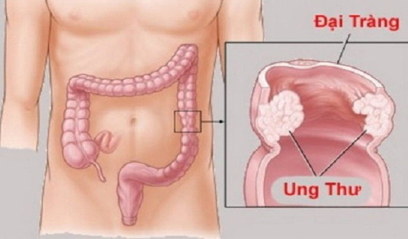 Ung thư đại trực tràng di căn