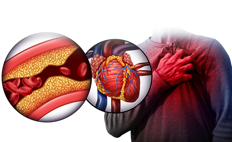 Điều trị và phòng ngừa máu nhiễm mỡ: Những điều bạn cân biết 1