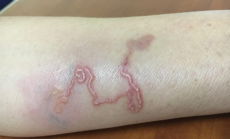 Bệnh giun lươn hình thành khi&nbsp;ấu trùng giun lươn xâm nhập vào cơ thể bằng cách chui qua da