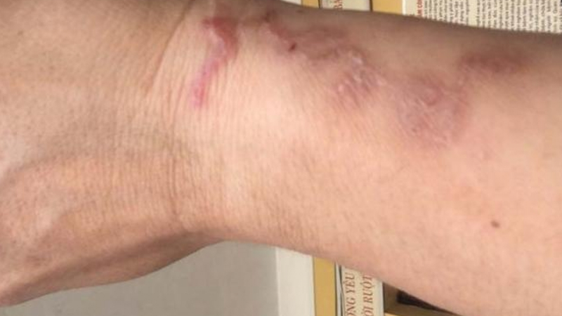 Việc điều trị giun lươn&nbsp;sẽ mất rất nhiều thời gian và chi phí