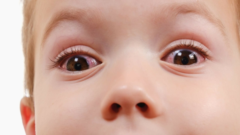 Điều trị và phòng tránh mắt bị lông quặm hiệu quả 2