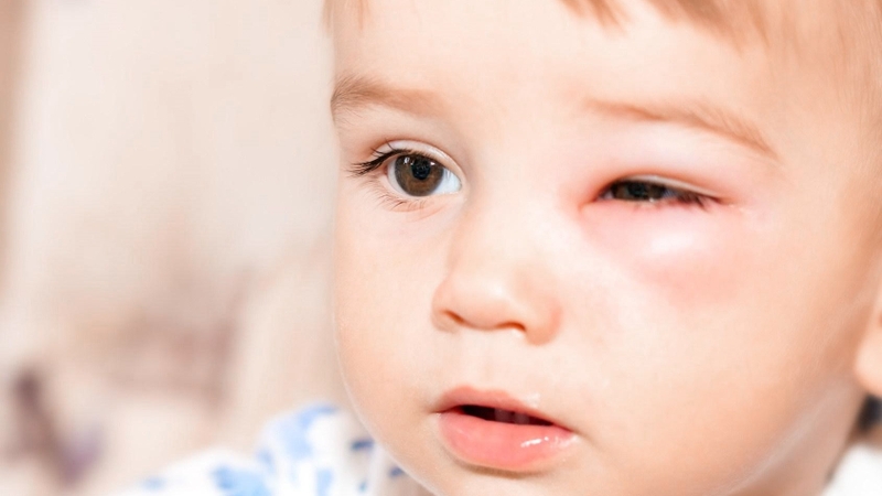 Điều trị và phòng tránh mắt bị lông quặm hiệu quả 3