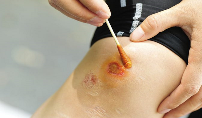 Vệ sinh sạch sẽ xung quanh vết thương rồi bôi trực tiếp một lớp thuốc mỏng lên vết thương hở