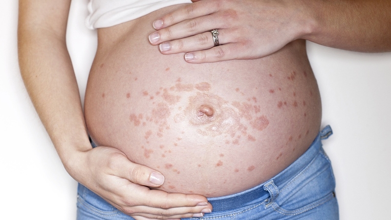 Điều trị viêm da cơ địa khi mang thai như thế nào cho an toàn 2