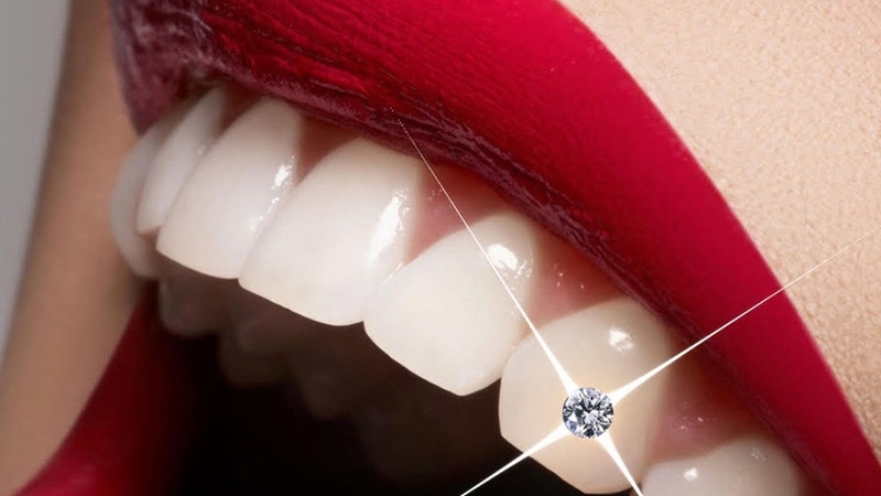 Đính đá răng khểnh có tốt không? 1