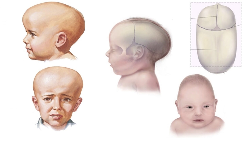 Dính khớp sọ bẩm sinh: Nguyên nhân, triệu chứng, cách điều trị 1