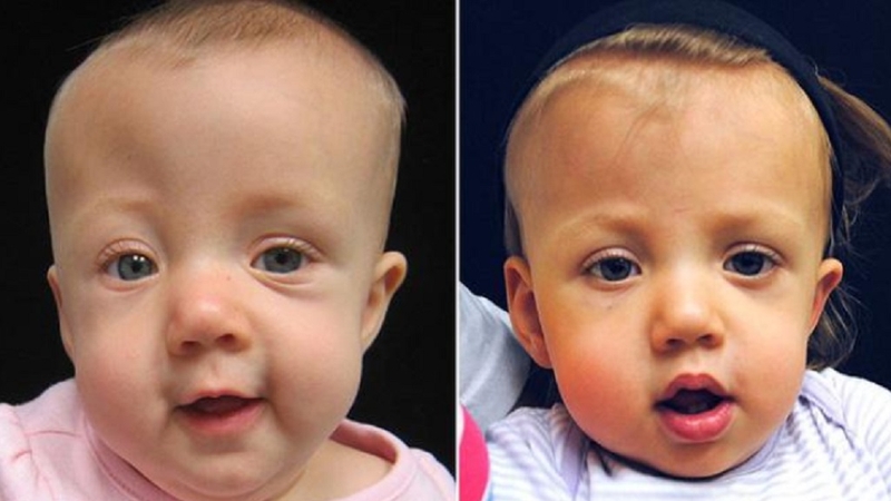 Dính khớp sọ sơ sinh ở trẻ em: Nguyên nhân, triệu chứng nhận biết và cách điều trị bệnh 1