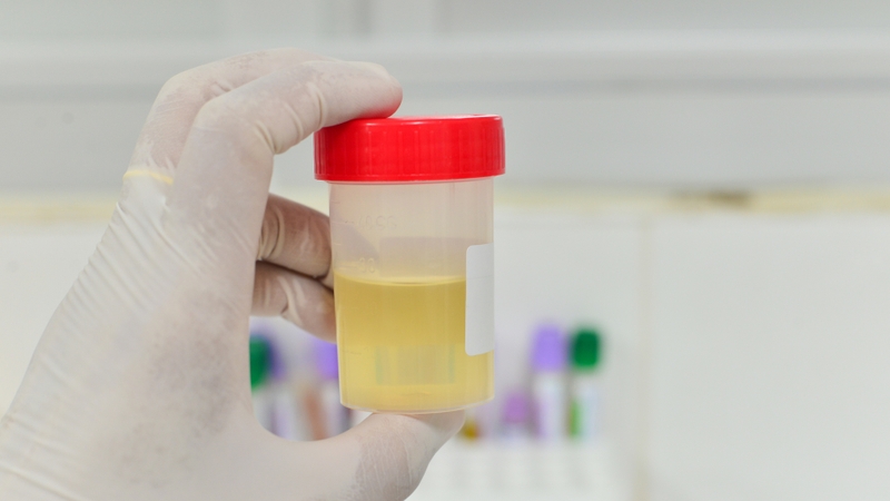 Kết quả âm tính cho thấy không có sự hiện diện bất thường của protein trong nước tiểu hoặc lượng protein rất thấp