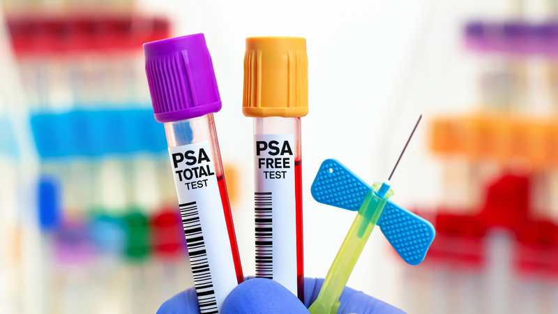 Định lượng PSA toàn phần là một xét nghiệm quan trọng giúp đánh giá sức khỏe tuyến tiền liệt