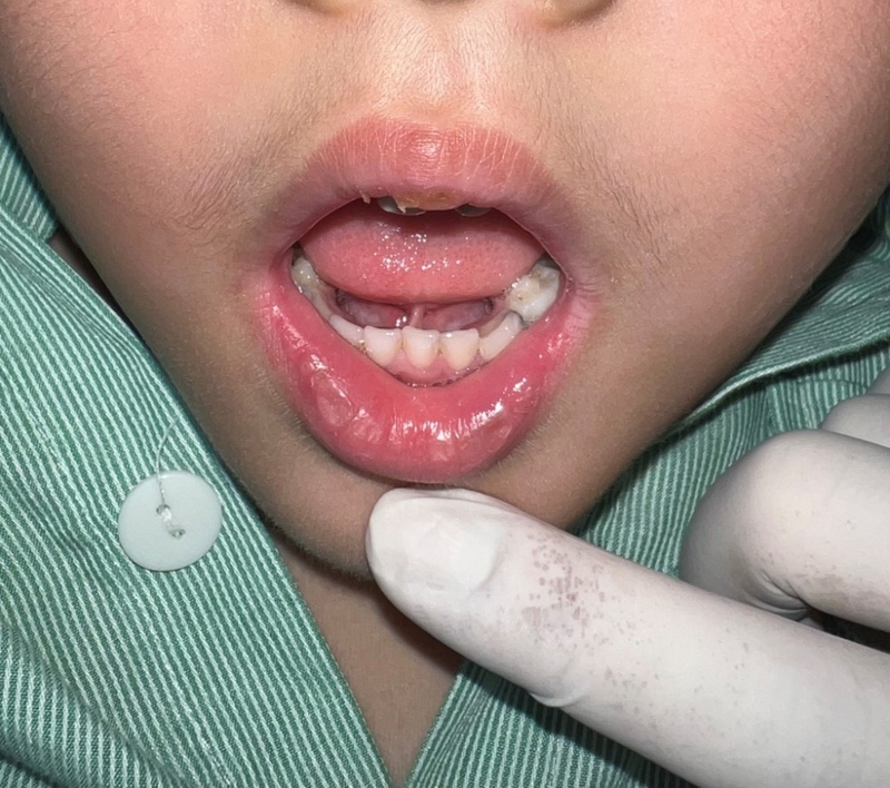 Dính thắng lưỡi có di truyền không? Ảnh hưởng của dính thắng lưỡi 1