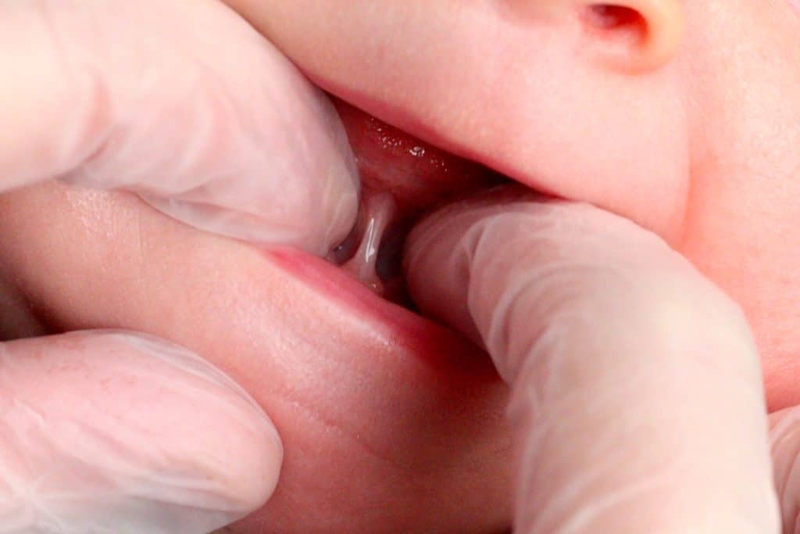 Dính thắng lưỡi ở trẻ là gì? Nguyên nhân, dấu hiệu và cách xử trí 1