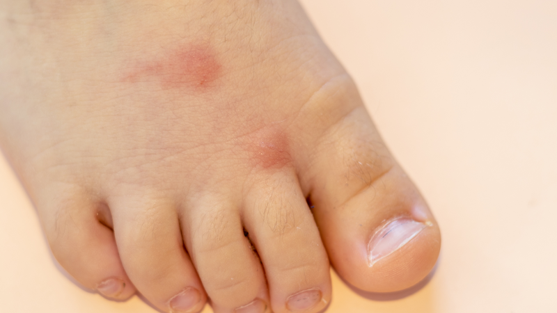 Dizigone Nano Bạc có thể dùng cho trường hợp muỗi đốt, côn trùng cắn