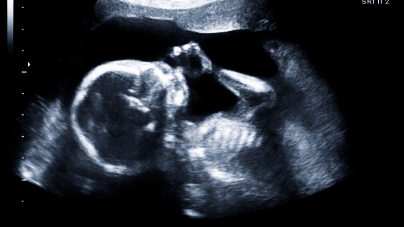 Chỉ số siêu âm đo được < 25mm ở giai đoạn thai nhi đã đủ ngày tháng chào đời