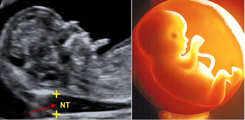 Đo độ mờ da gáy bao nhiêu tiền 1