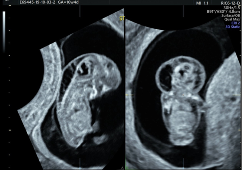 Độ mờ da gáy 1.2 là gì? Có nguy hiểm cho thai nhi không? 2