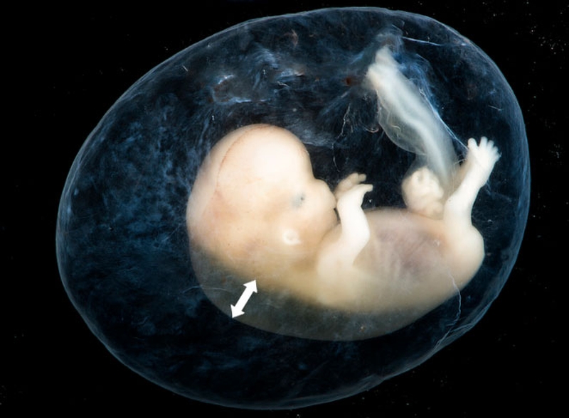 Độ mờ da gáy 1.2 là gì? Có nguy hiểm cho thai nhi không? 3