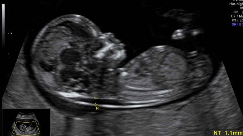 Độ mờ da gáy 1.1mm có cần làm double test không là băn khoăn của nhiều mẹ bầu