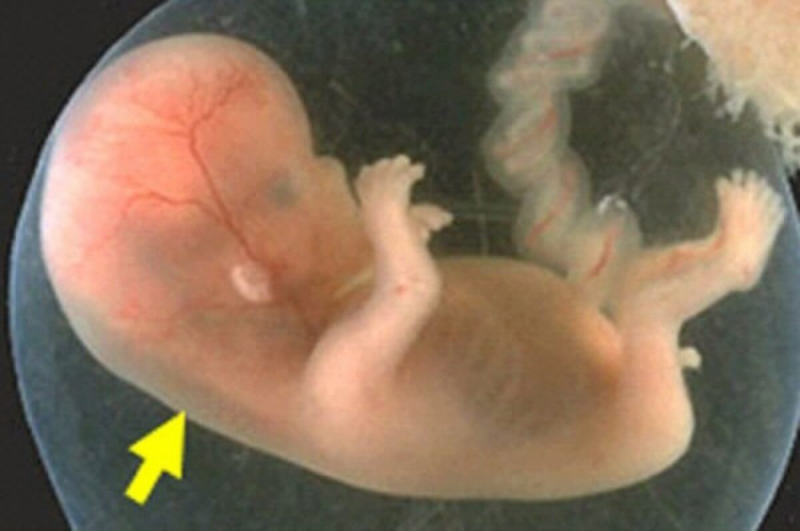 Độ mờ da gáy 1.8mm có bình thường không?