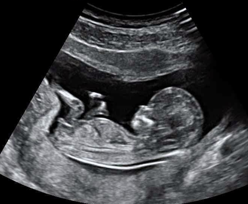 Độ mờ da gáy 1.8mm có bình thường không?