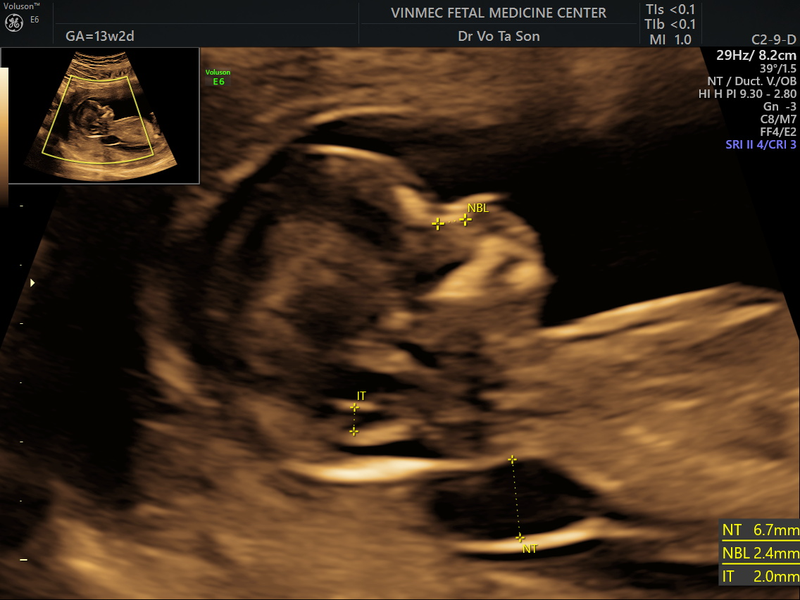 Độ mờ da gáy 1.8mm có bình thường không?