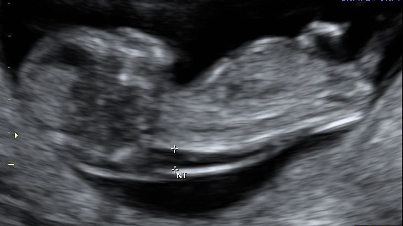 Độ mờ da gáy 3.2mm có bình thường không? 1